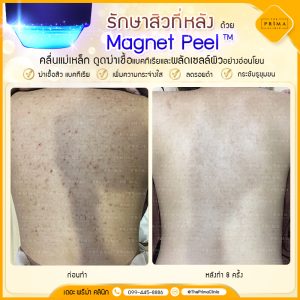 รักษาสิวหลัง รีวิว