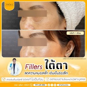 รีวิว ฉีดฟิลเลอร์ ใต้ตา