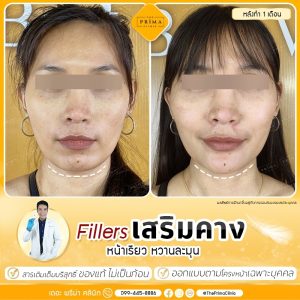 รีวิว ฉีดฟิลเลอร์ คาง หน้าเรียว