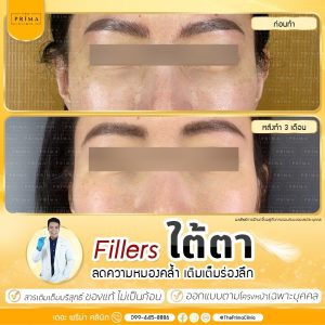 รีวิว ฉีดฟิลเลอร์ ใต้ตา