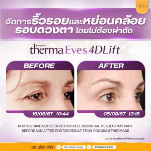 therma eyes 4d lift