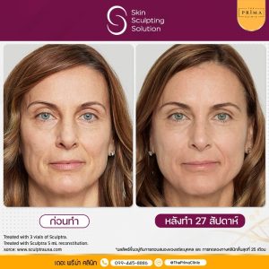 Sculptra รีวิว