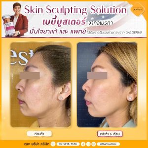 Sculptra รีวิว 6 เดือน (1)