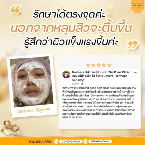 รักษาหลุมสิว รีวิว review