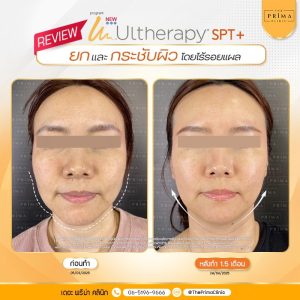 Ulthera review รีวิว อัลเทอร่า ชลบุรี (1)