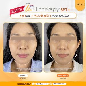 Ulthera review รีวิว อัลเทอร่า ชลบุรี (2)