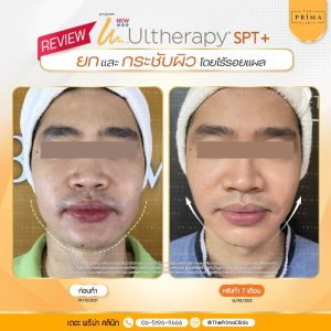 Ulthera review รีวิว อัลเทอร่า ชลบุรี (3)