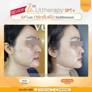 รีวิว Ulthera (1)