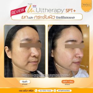 รีวิว Ulthera (3)