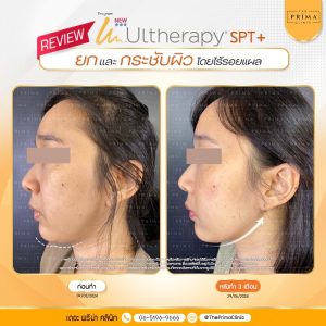 รีวิว Ulthera