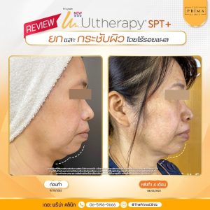 รีวิว Ulthera (7)