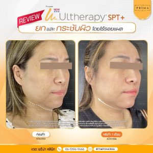 รีวิว Ulthera (9)