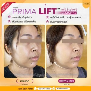 รีวิว prima lift MMFU ultraformer (1)