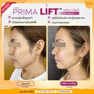 รีวิว prima lift MMFU ultraformer (2)