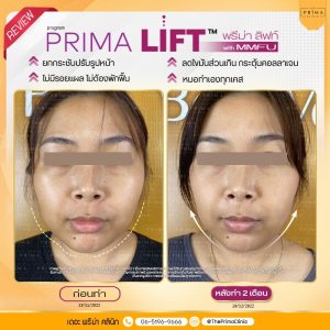 รีวิว prima lift MMFU ultraformer (6)