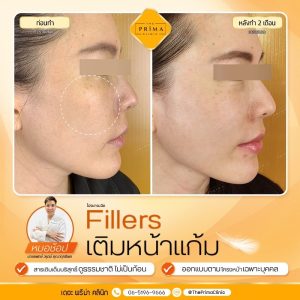 รีวิว ฟิลเลอร์แก้มส้ม