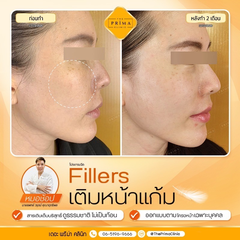 รีวิว ฟิลเลอร์แก้มส้ม