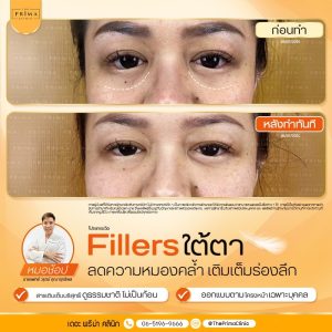 รีวิว ฟิลเลอร์ใต้ตา