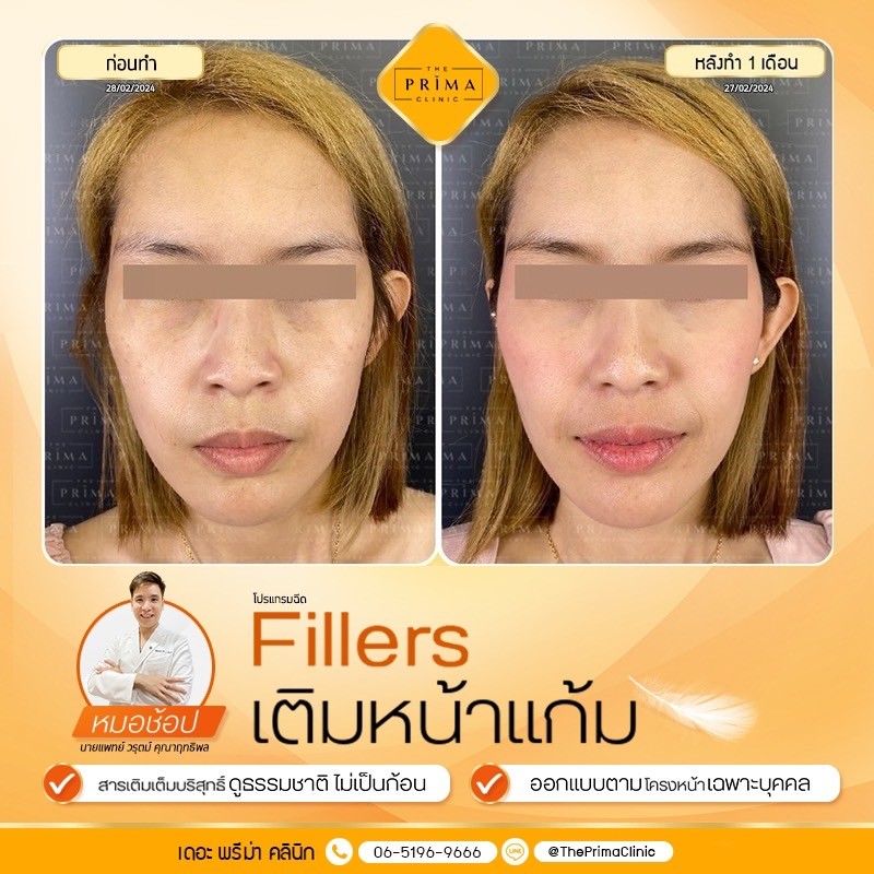 ฟิลเลอร์ แก้มตอบ หน้าแก้ม รีวิว