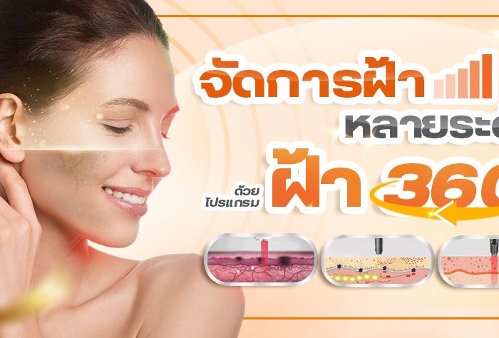 รักษาฝ้าแบบบูรณาการ ด้วยโปรแกรมฝ้า 360