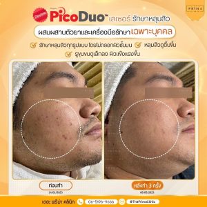 รีวิว Pico หลุมสิว 3 ครั้ง
