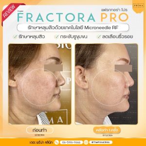 รีวิว Fractora pro