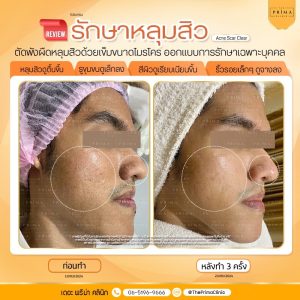 รีวิว รักษาหลุมสิว 3 ครั้ง