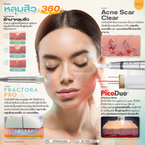 หลุมสิว 360 acne scar 360