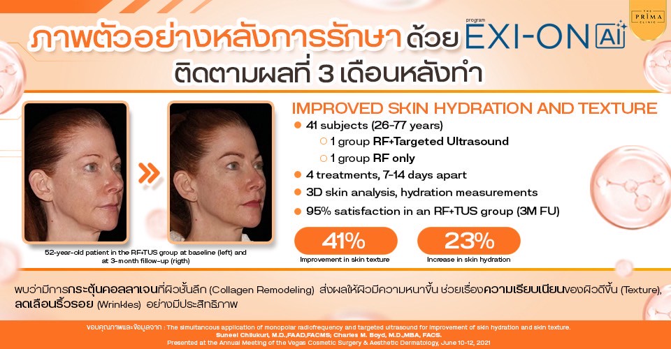 รีวิว exion