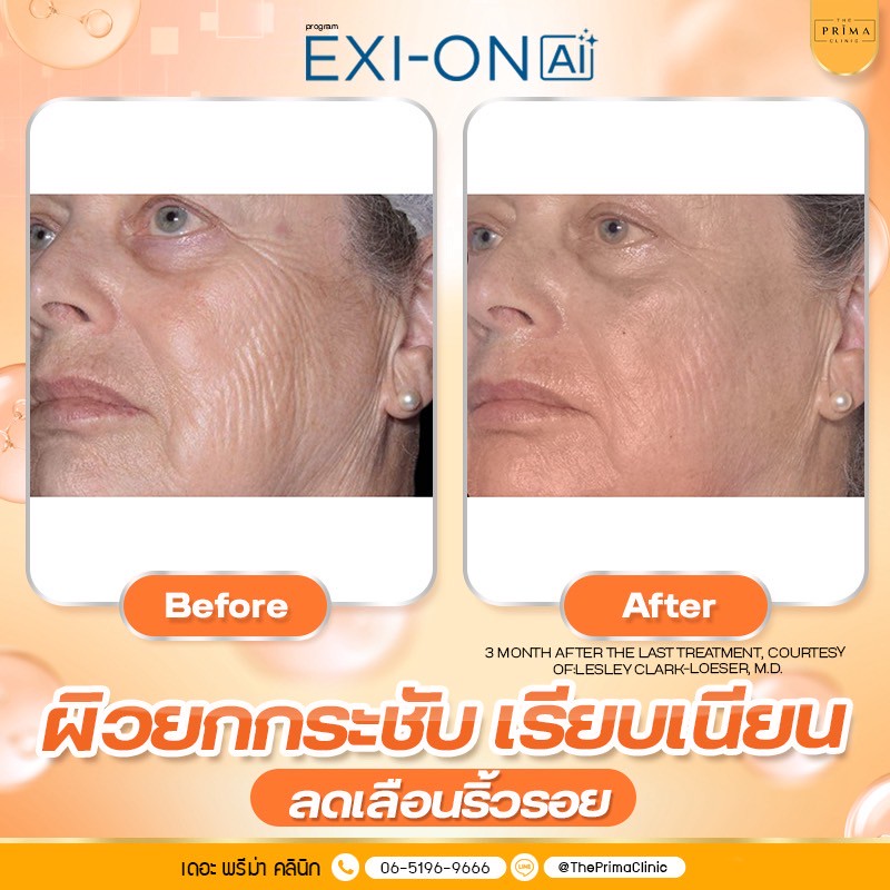 Exion รีวิว (4)