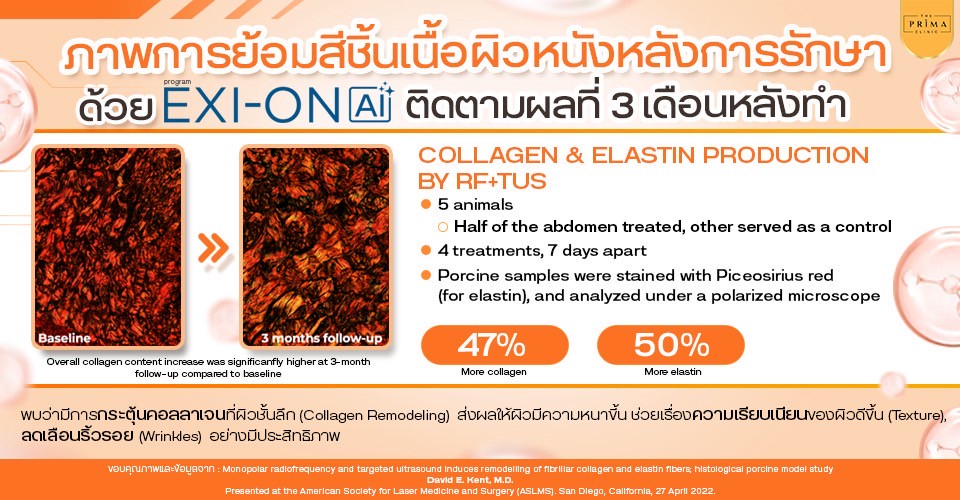 exion ดียังไง