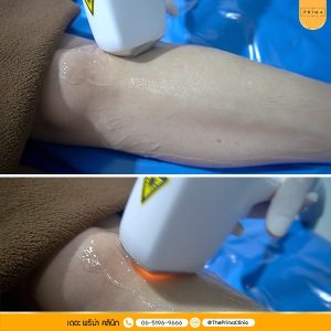 เลเซอร์เย็น diode laser กำจัดขน (2)