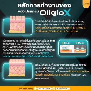 Thai infographic about how OligioX works to boost collagen and elastin, with skin cross‑section illustrations and RF energy details to reduce wrinkles.