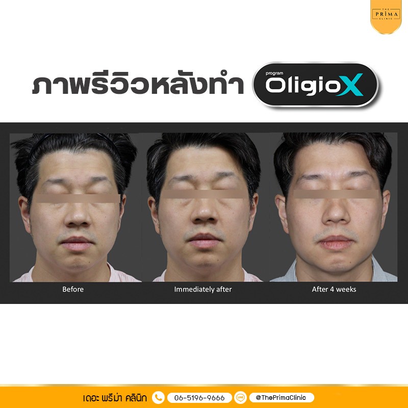 Oligio X รีวิว review