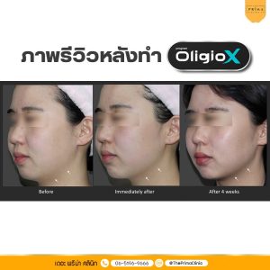 Oligio X รีวิว review