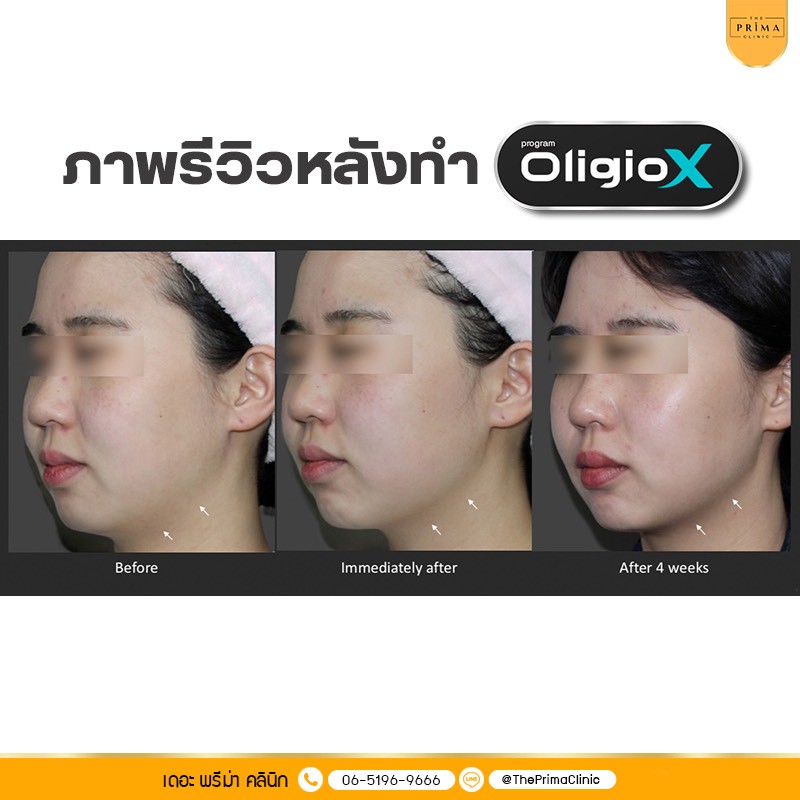 Oligio X รีวิว review
