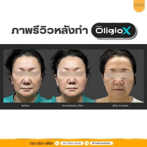 Oligio X รีวิว review