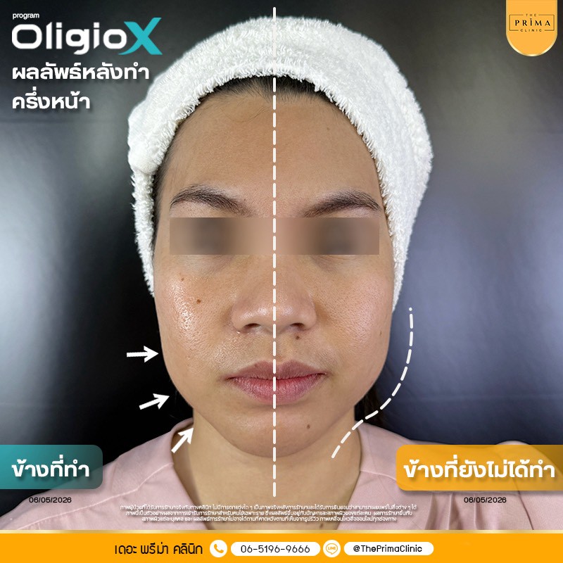 Oligio X รีวิว