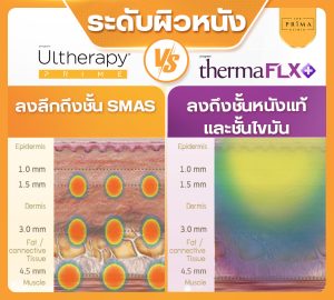 Ulthera Prime vs Thermage FLX (7)