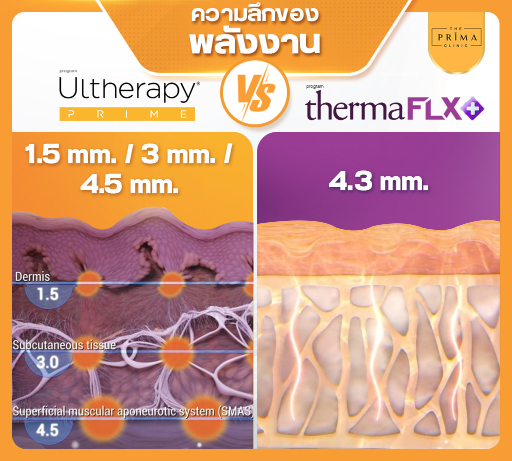 Ulthera Prime vs Thermage FLX (8)