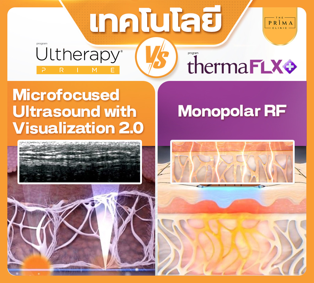 Ulthera Prime vs Thermage FLX (9)